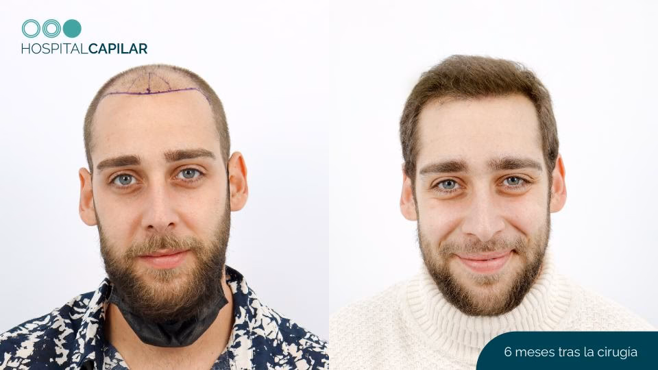 ¿Cuáles son las desventajas del injerto capilar?