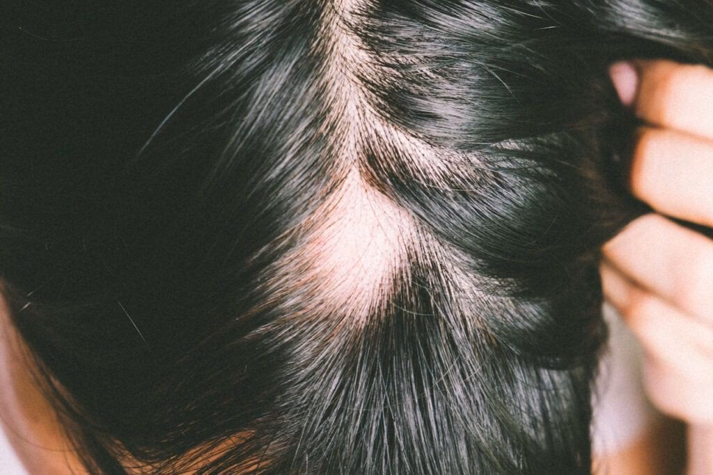¿Cómo recuperar el cabello caído por estrés?