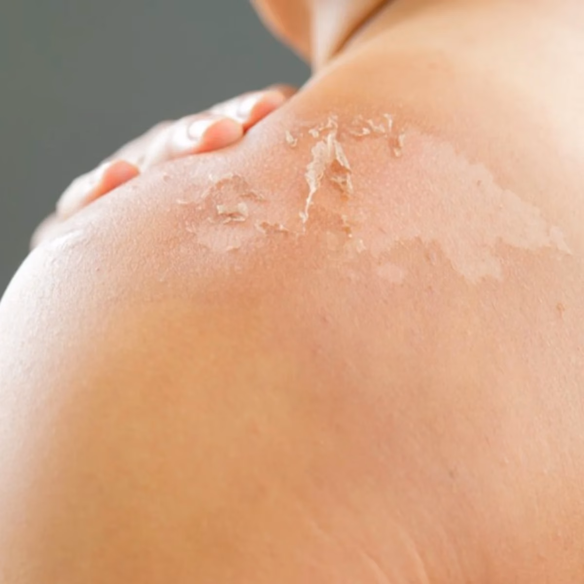 ¿Cómo puedo recuperar el cabello quemado por el sol?