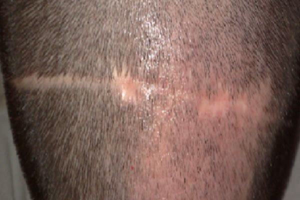 ¿Es posible injertar cabello en una cicatriz?