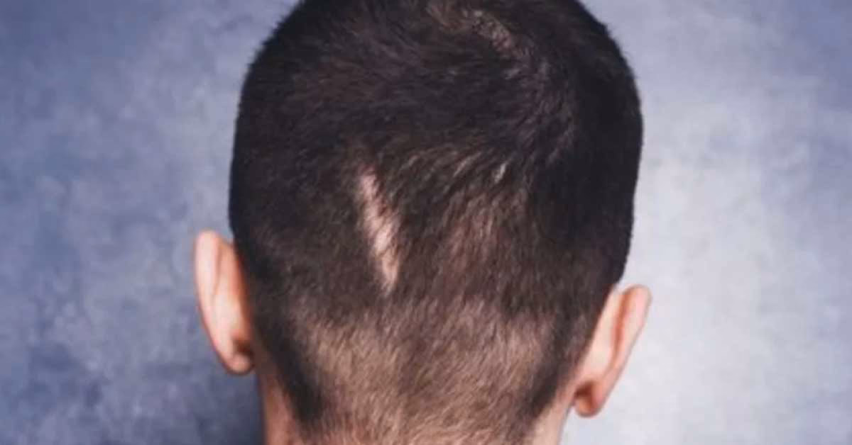 ¿Es posible injertar cabello en una cicatriz?