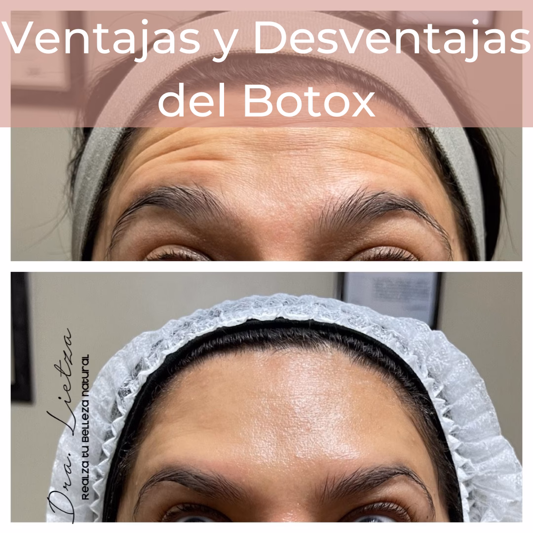 ¿En qué partes del rostro se puede aplicar el bótox?