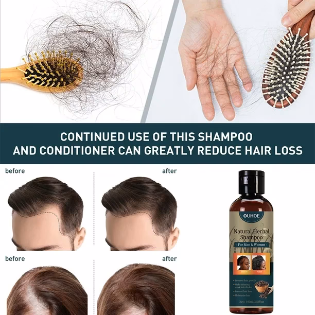 ¿Puede el champú arreglar las entradas del cabello?