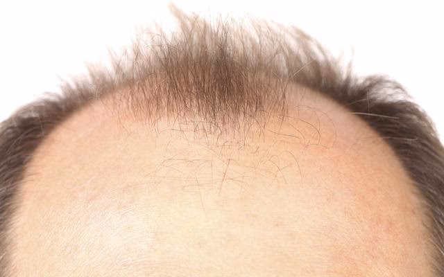 ¿Cuánto tiempo tarda en crecer el cabello arrancado de raíz?