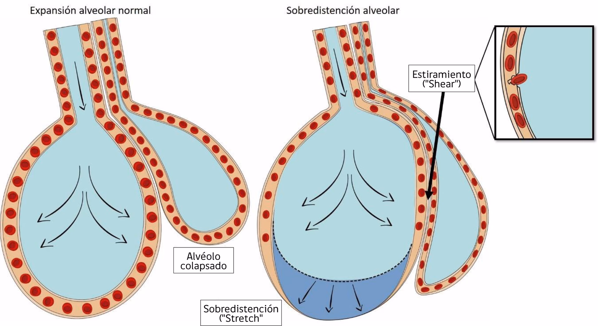 ¿El SDRA aumenta la permeabilidad capilar?