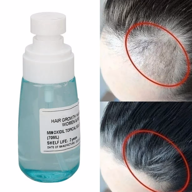 ¿Cómo se llama el spray que hace crecer el cabello?