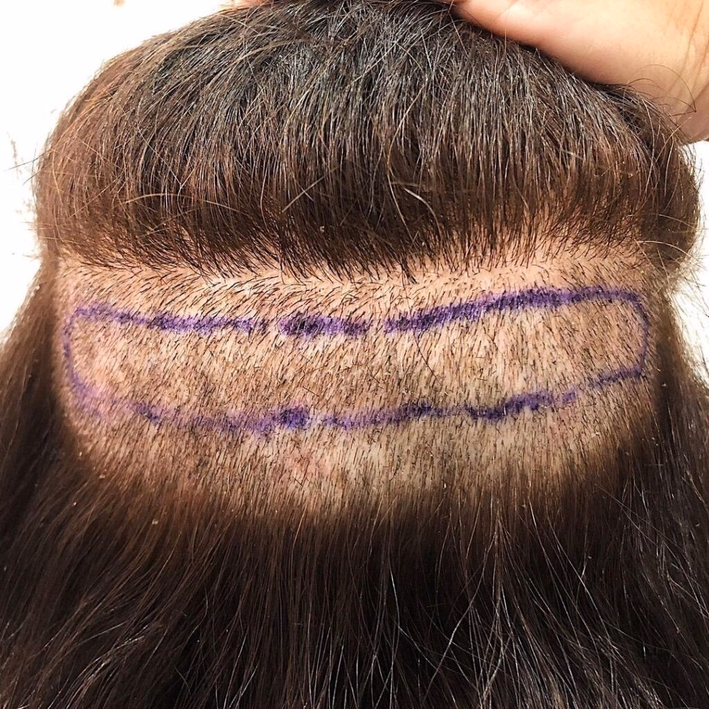 ¿Cuáles son los tipos de trasplantes capilares?