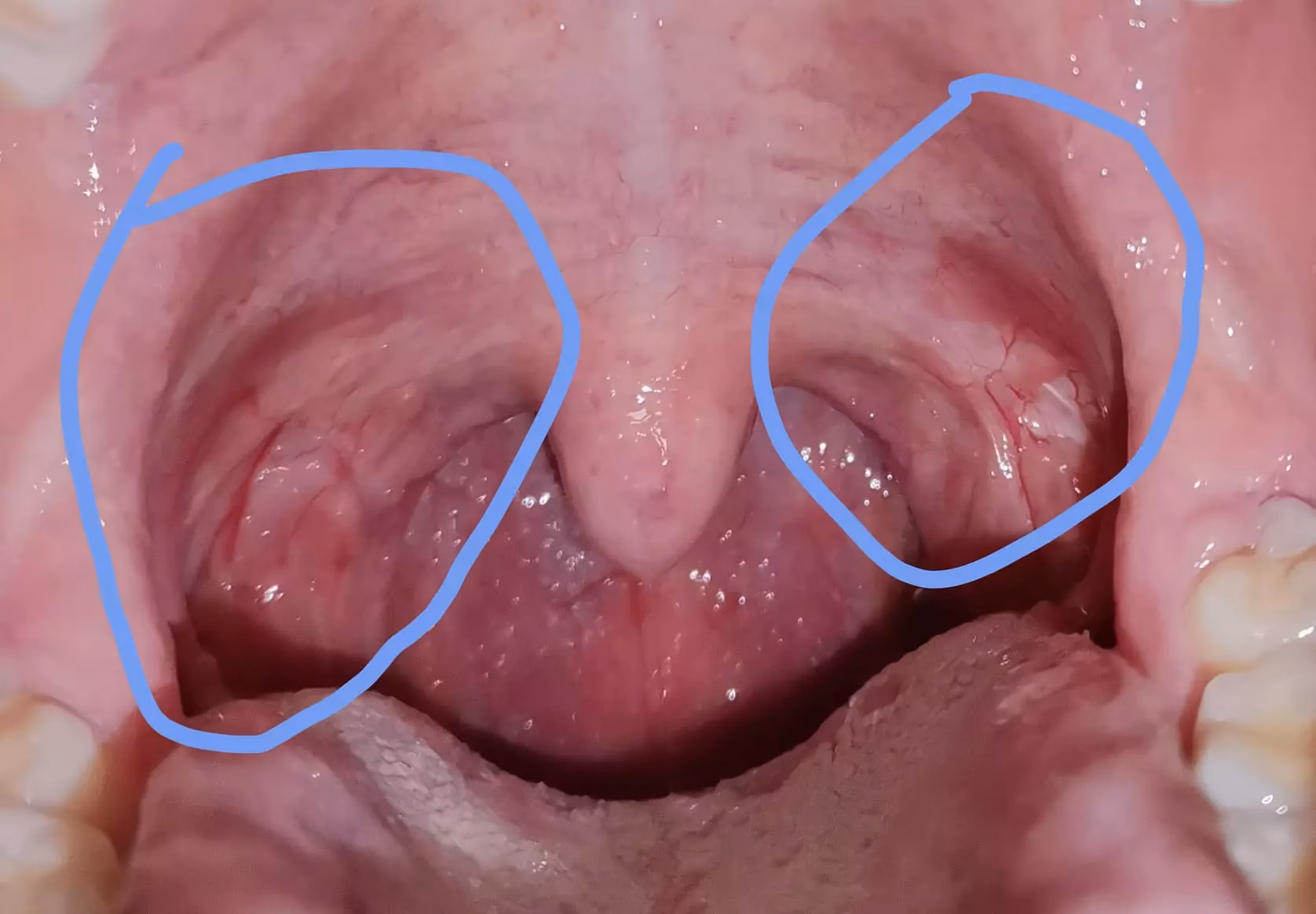 ¿Porque siento algo atravesado en la garganta?