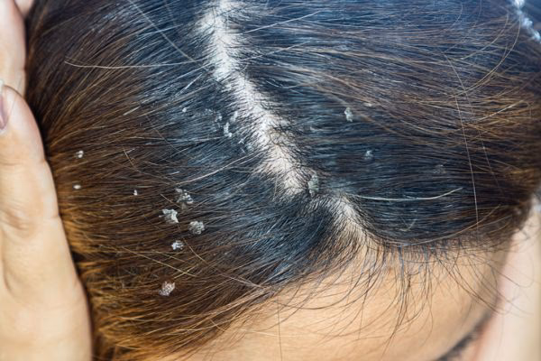 ¿Cómo calmar la picazón del cuero cabelludo?