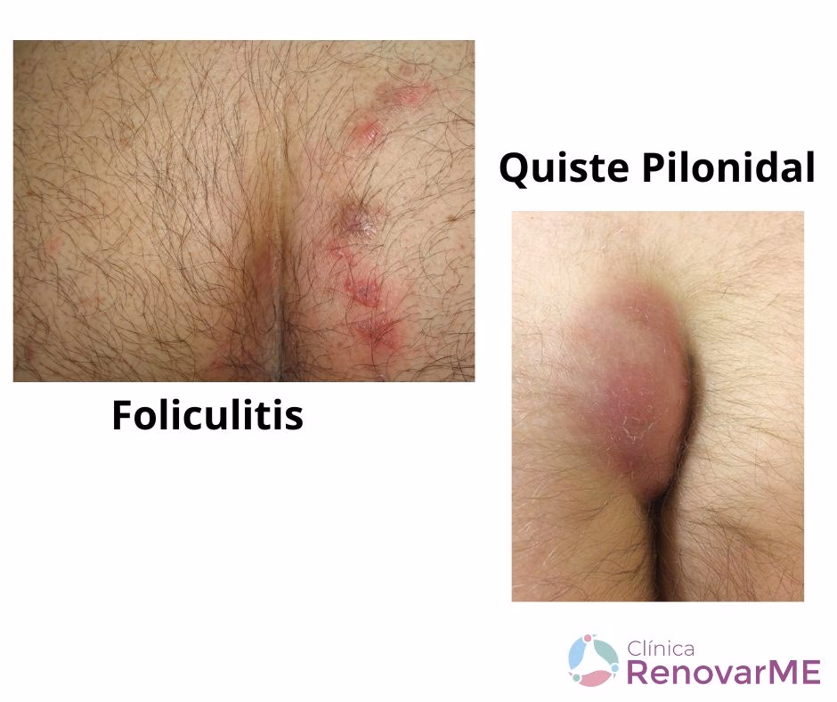 ¿Cómo quitar un pelo encarnado en la ingle?