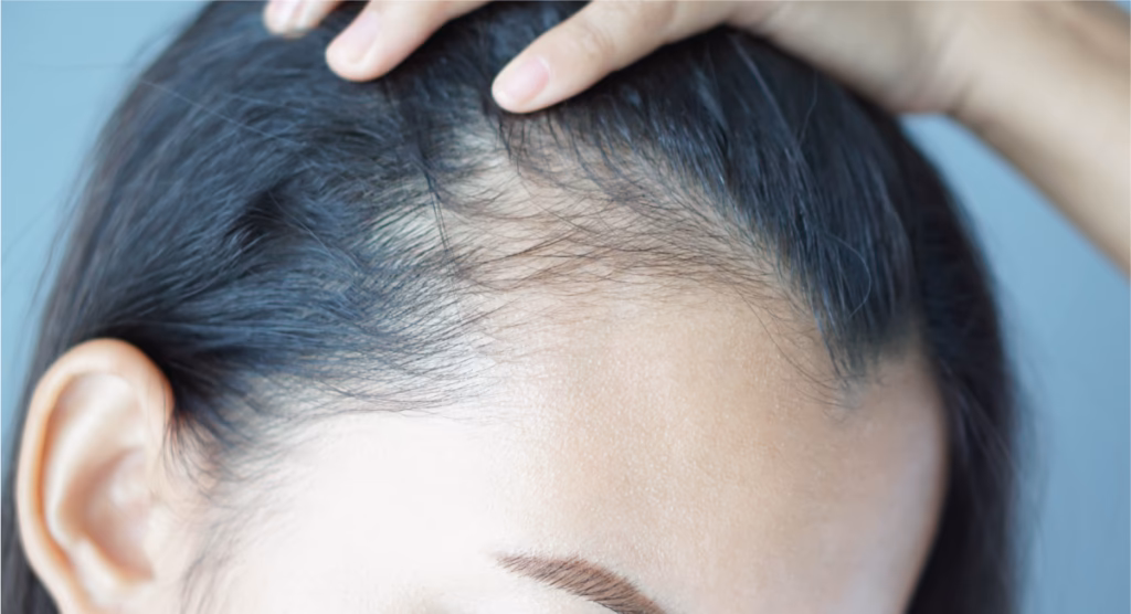 ¿Qué tipo de alcohol es bueno para el crecimiento del cabello?