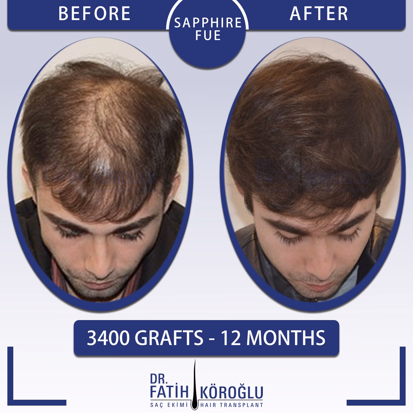 ¿Qué pasa si transpiro mucho durmiendo?