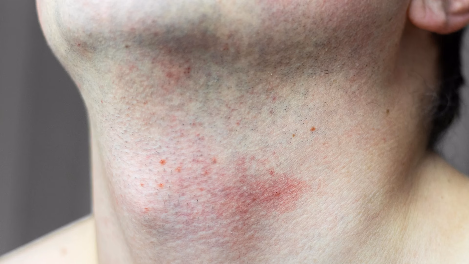 ¿Cuánto tiempo dura la irritación por afeitarse?