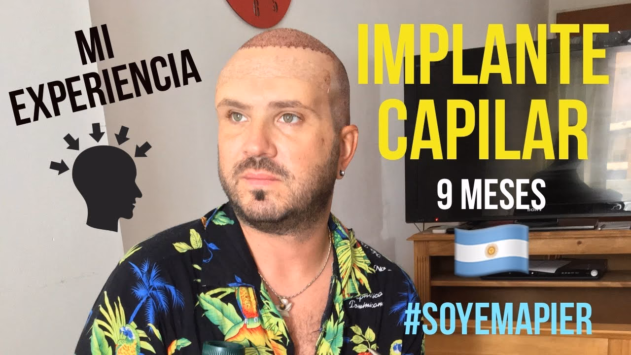 ¿Cuánto cuesta un trasplante capilar completo?