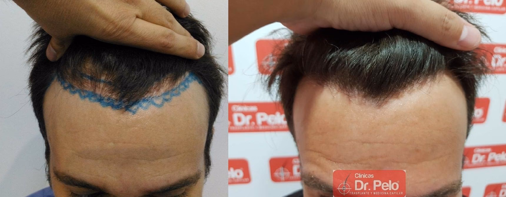 ¿Cómo se recupera la densidad del cabello?