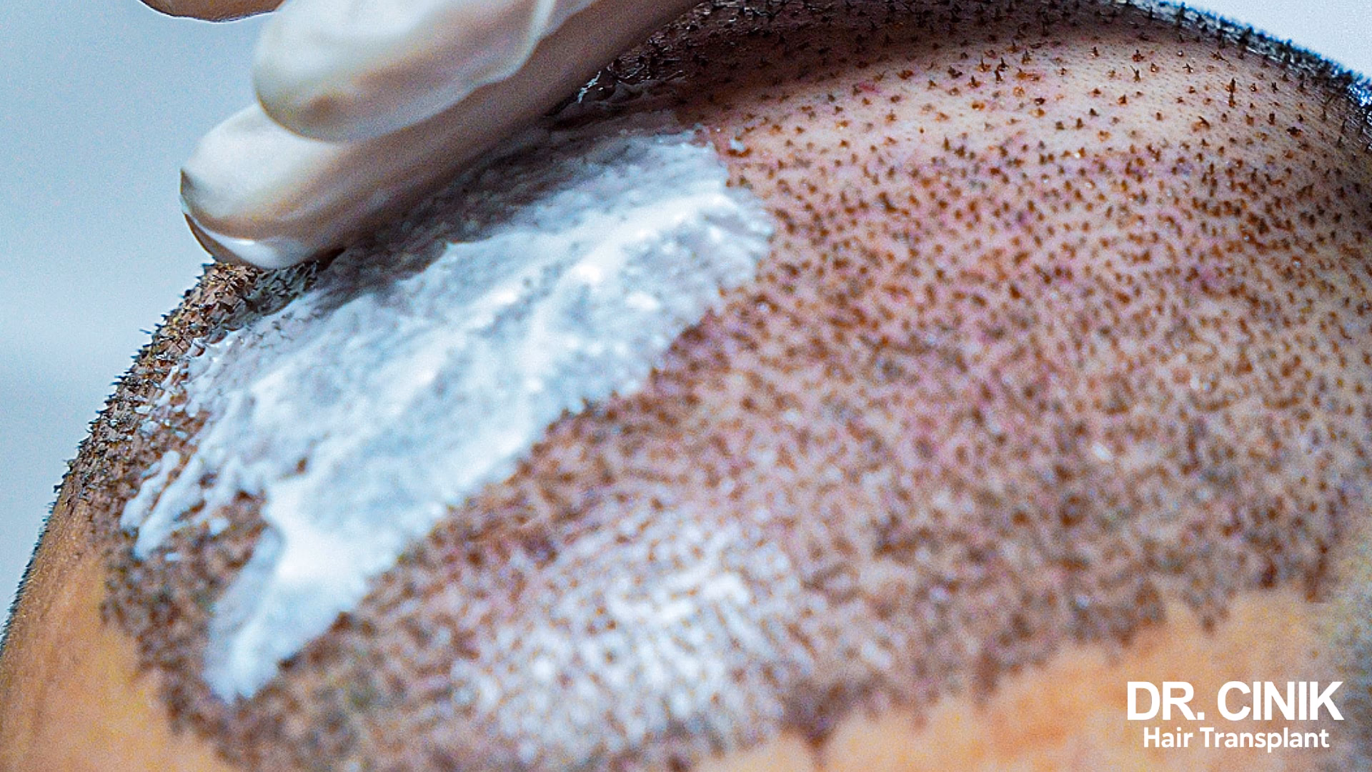 ¿Qué pasa si se infecta un injerto capilar?