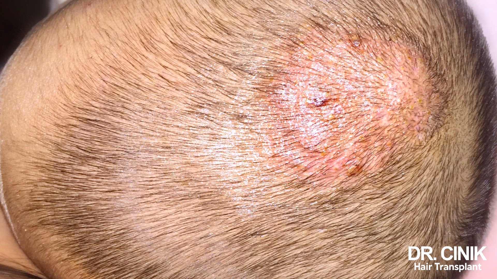 ¿Cómo saber si un trasplante de cabello está infectado?