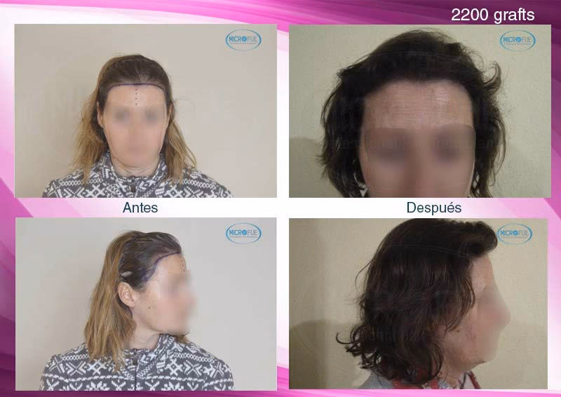 ¿Qué ciudad de Turquía es mejor para el trasplante de cabello?