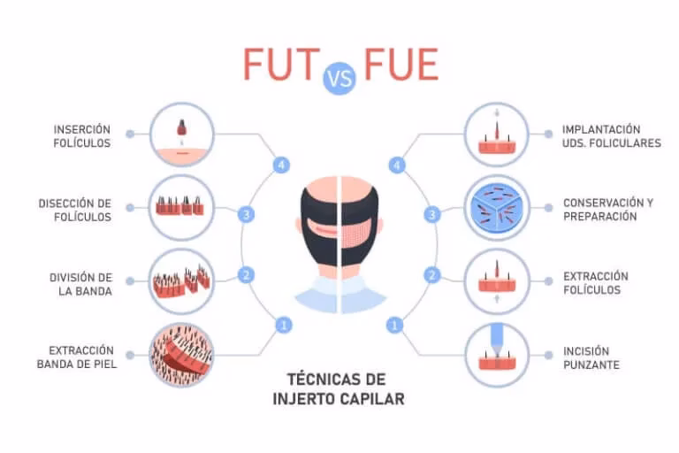 ¿Qué es la técnica FUSS para el trasplante capilar?