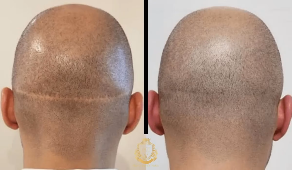¿Es posible realizar un trasplante de cabello sobre piel con cicatrices?