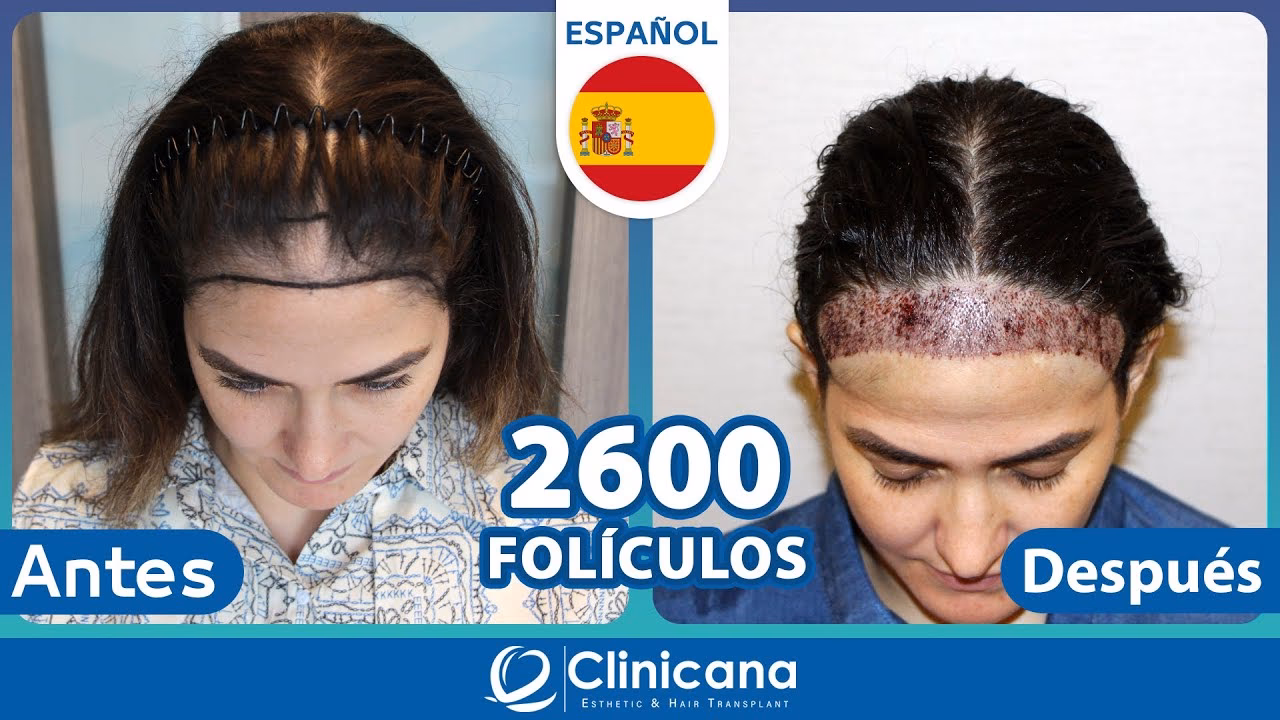 ¿Cuánto vale un trasplante de cabello en Turquía?