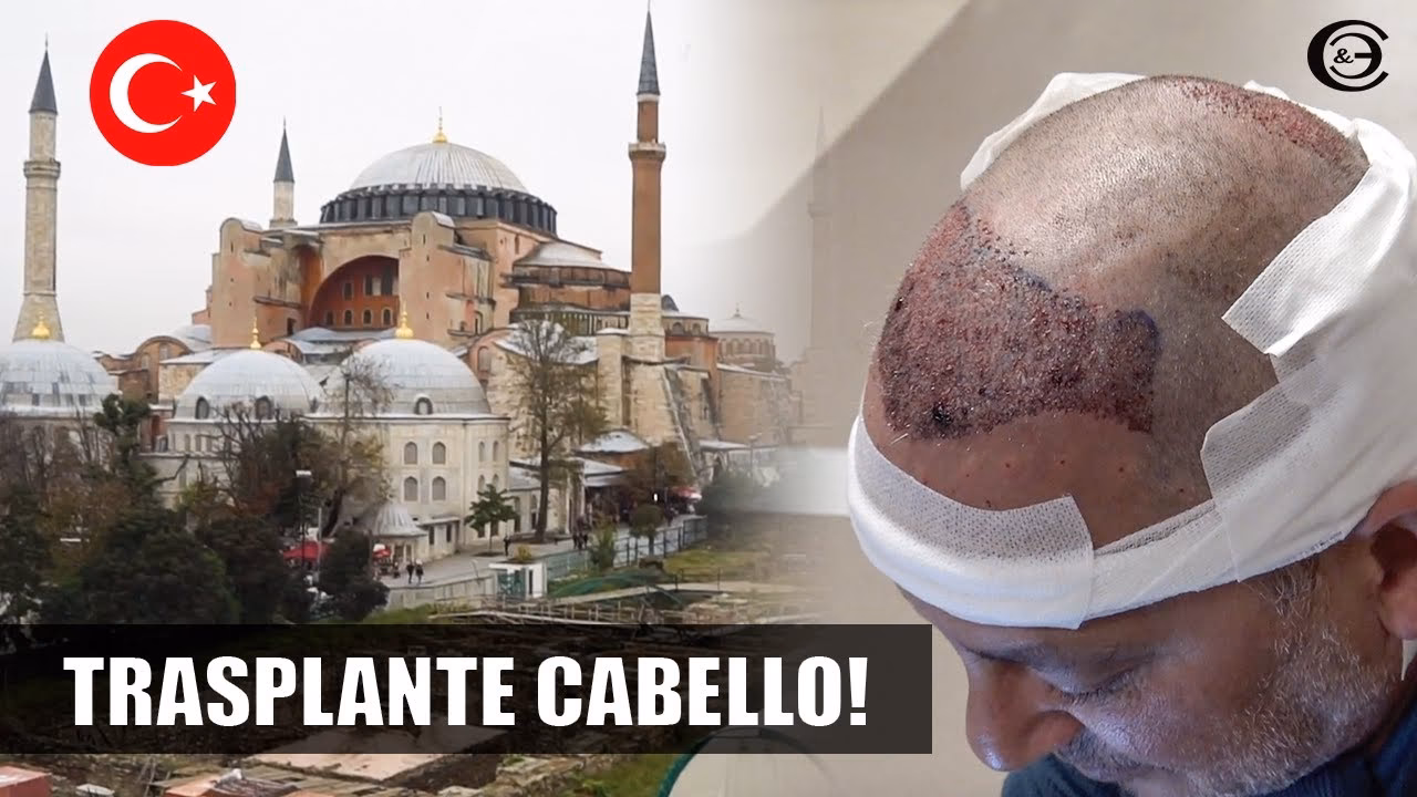 ¿Cuánto tiempo debo permanecer en Turquía después de un trasplante de cabello?