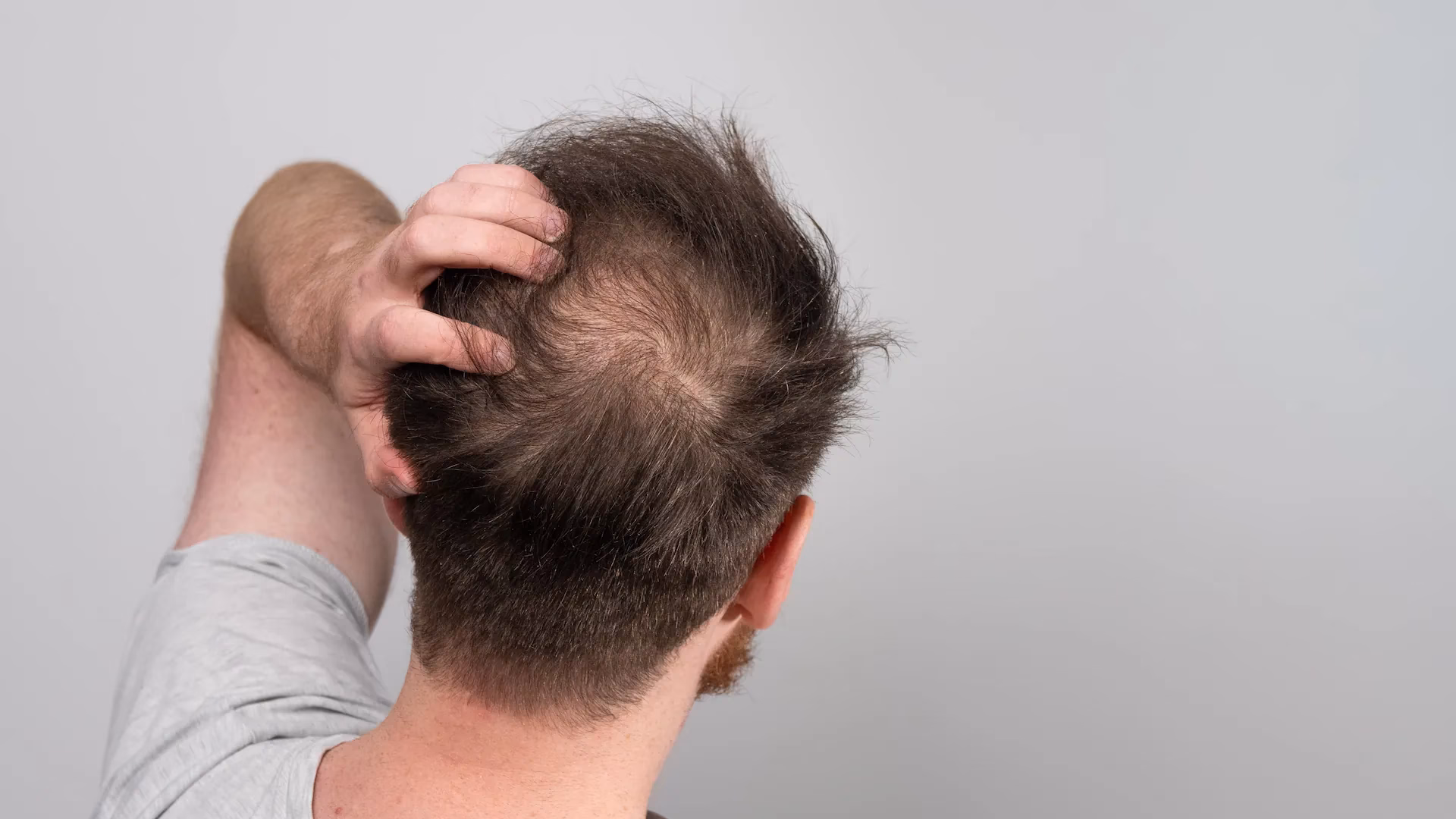 ¿Qué aceite sirve para la alopecia?