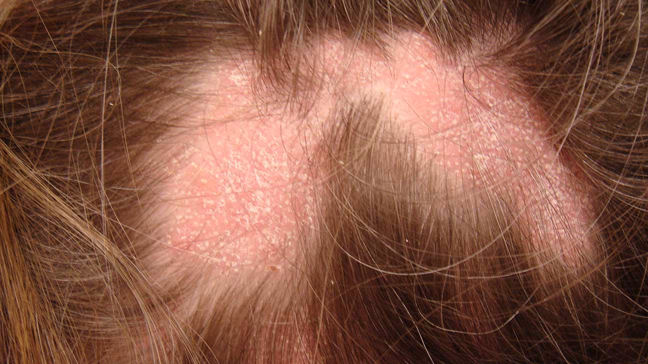 ¿Cómo eliminar el virus zóster?